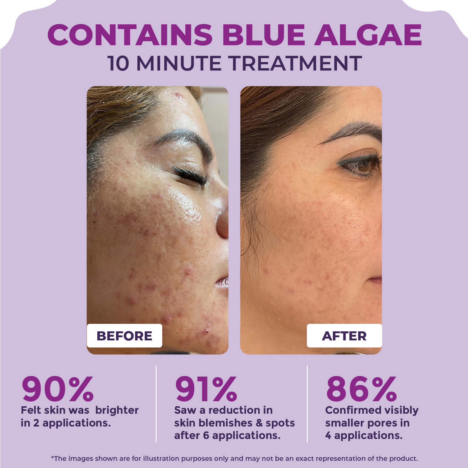 Sanfe 25% AHA + 2% BHA Exfloating Peeling Solution
