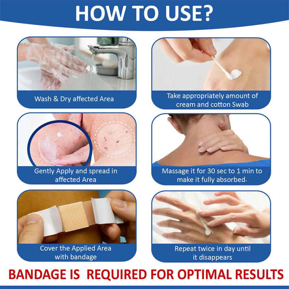 7 Days Natural Wart Remover Cream with AHA- BHA