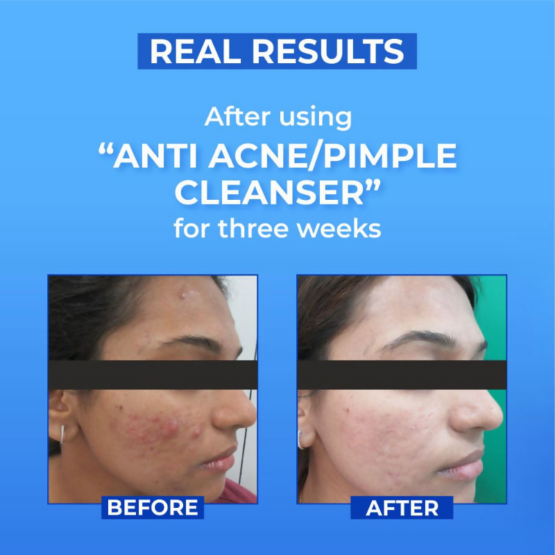 Dr.Sakhiya Anti Acne/Pimple Face Cleanser