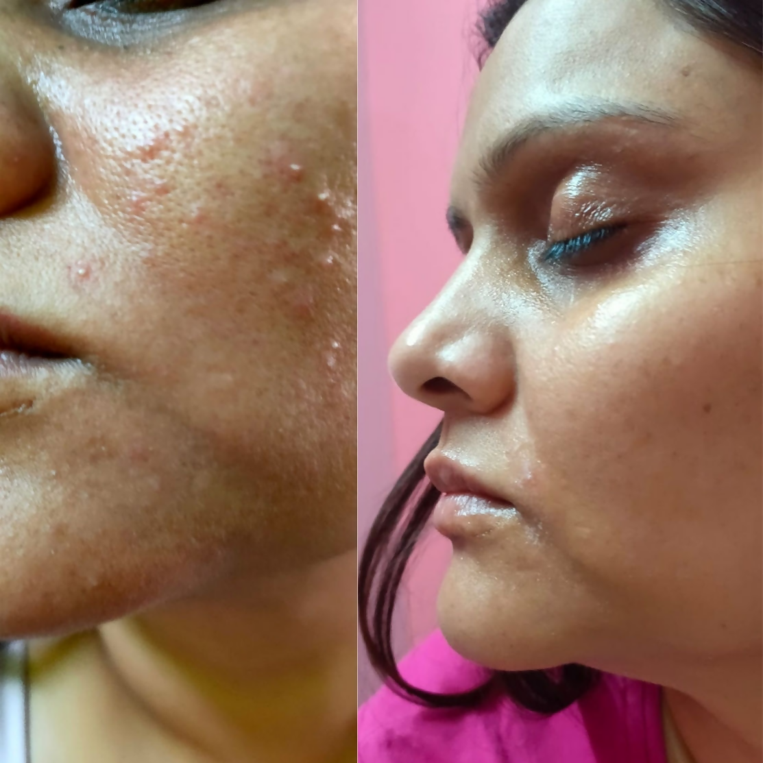 House of Beauty Acne Drying Serum